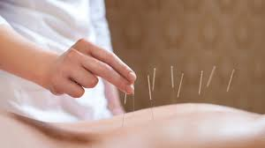 Acupuntura em Santo André — All Care Fisioterapia em Santo André